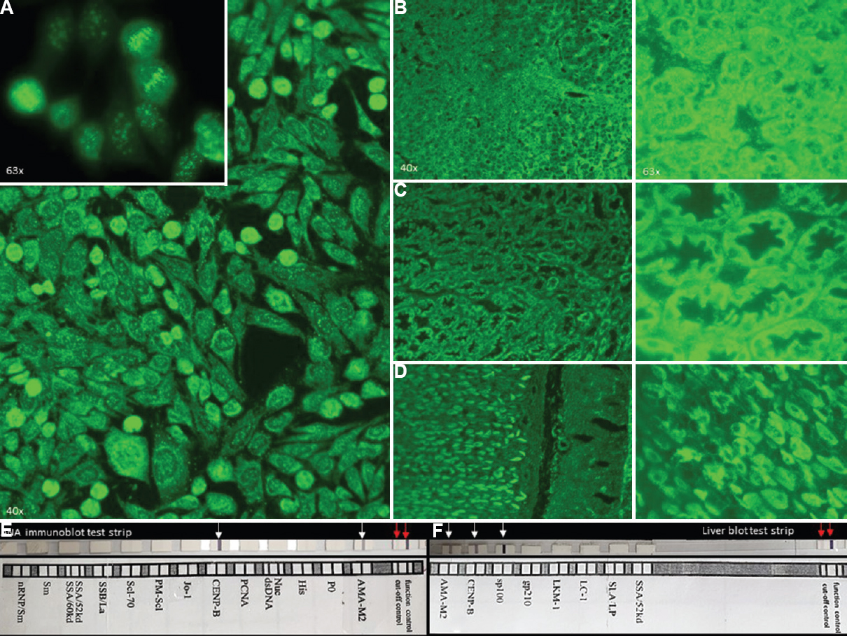 (A) Indirect immunofluorescence antinuclear antibody (IIF-ANA) test on Hep-2 images showing a peculiar pattern in the form of haphazardly dispersed granules in both nucleus and cytoplasm and forming a zipper pattern within the mitosis (inset). (B-D) IIF-ANA test on composite section (rat liver, kidney tubules and gastric mucosa) showed classical anti-mitochondrial pattern in the form of granular positivity. (E) Antinuclear antibody and liver immunoblot are positive for CENPB (Centromere protein B), anti-mitochondrial-M2 (E and F, white arrow; red arrows are control bands) and (F) SP100 autoantibodies.